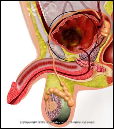 excretory system diseases. A part of the excretory system